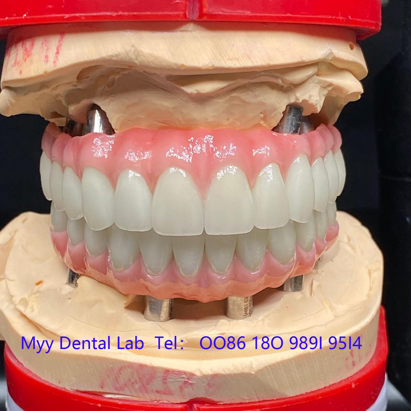 深圳種植牙加工廠 快速交付能力，7-10天周期